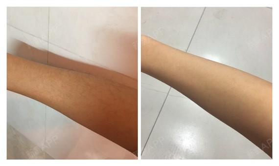 这是脱毛前和脱毛后的一个对比图
