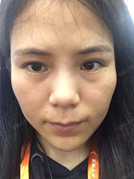 从小脸部就凹陷严重,看起来显老