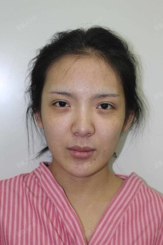 新氧的宝宝们,我是天津圣韩美芭比风格整形医生-张路坤,终于也可以为