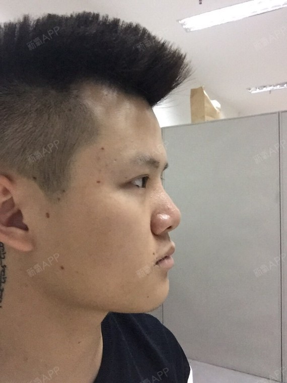 ryan丶choo激光点痣第2天美丽日记