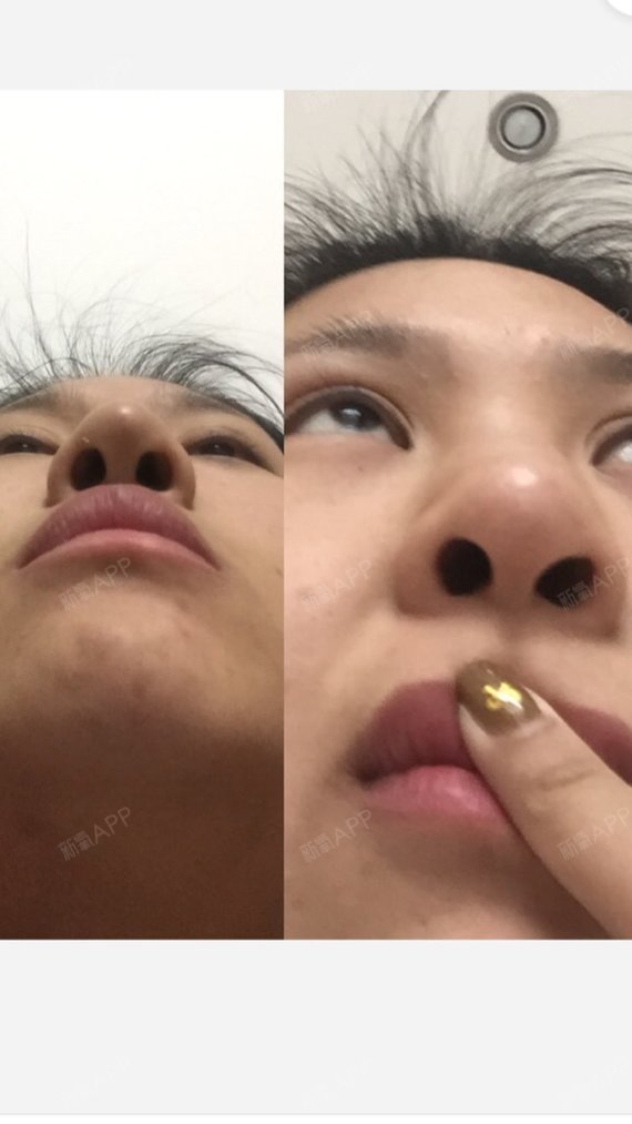 哈尔滨耳软骨复合隆鼻好不好_效果图_等我吃饱再减肥嗷耳软骨复合隆鼻