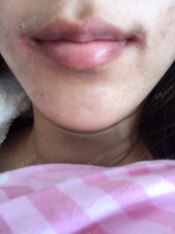 嘴角上扬术好不好_效果图_bio洪星杓做坏眼袋泪沟嘴角上扬术术后第70