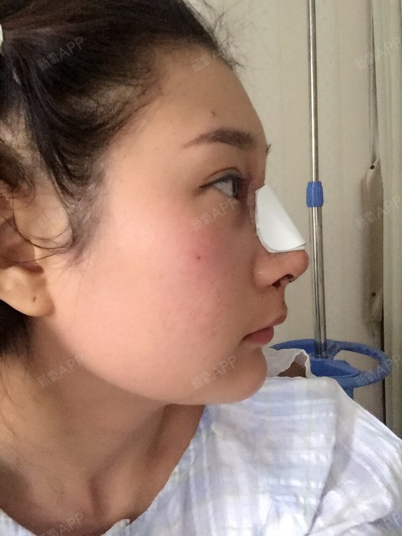 我之前做的l型假体已经开始下滑了,一心想修复,最头_圈子-新氧美容