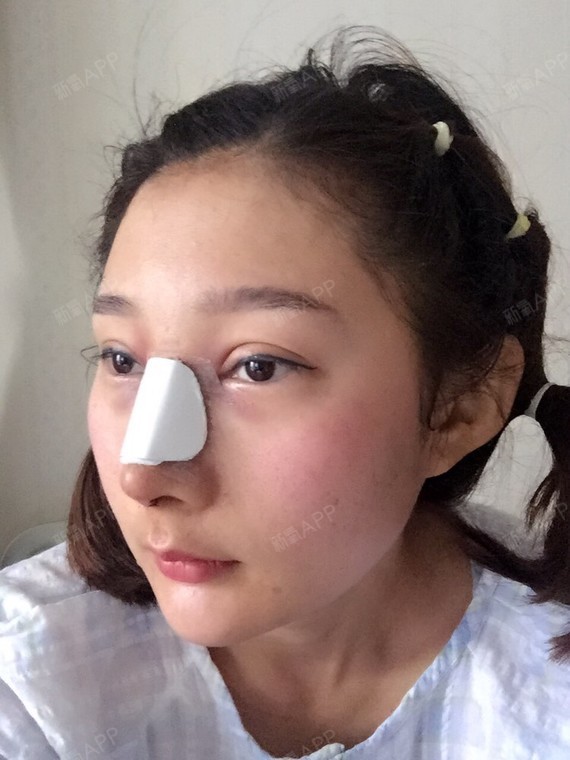 我之前做的l型假体已经开始下滑了,一心想修复,最头_圈子-新氧美容