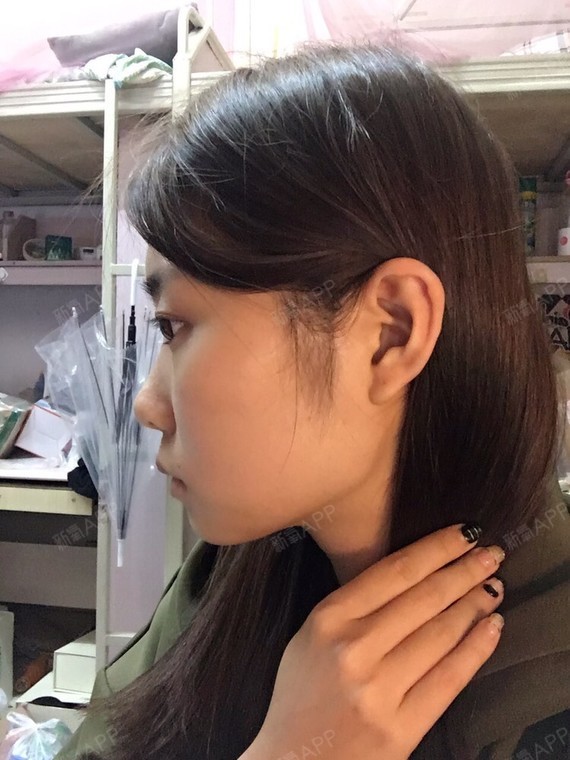 左右下颌角不对称并且下颌角很方,导致脸一_圈子-新氧美容整形