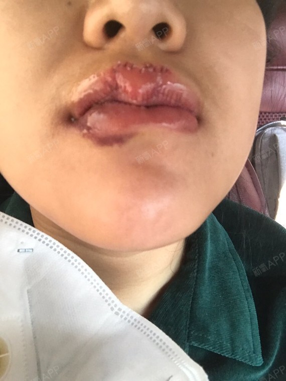 唇隐裂术后20天图片图片