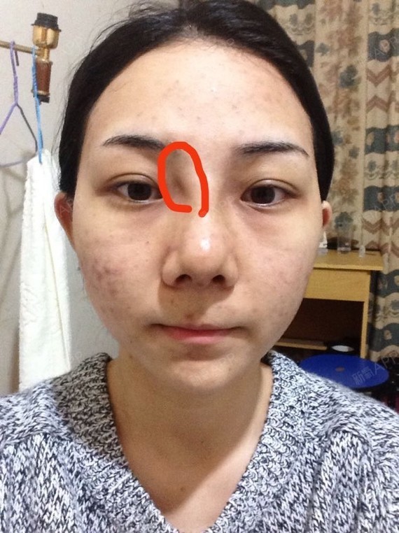 看图吧,鼻根部衔接不自然,这是什么情况