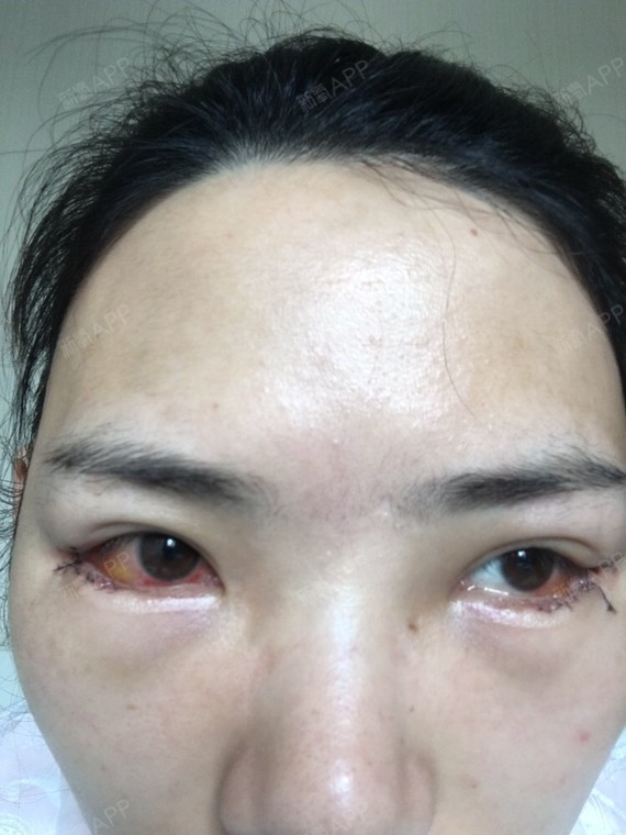 今天去医院换药了,眼睛结膜肿得很厉害,特别是右边的_圈子-新氧美容