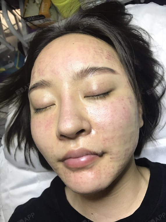 水光补水好不好_效果图_gsj0906水光补水术后第0天_新氧美容整形