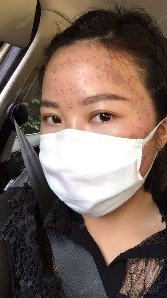 氧气罐黄金微针第1天美丽日记
