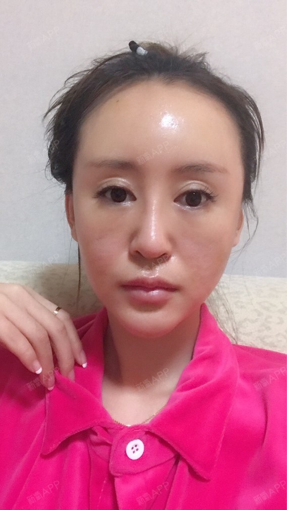 自体脂肪全脸填充好不好_效果图_张张张颖自体脂肪全脸填充术后第3天