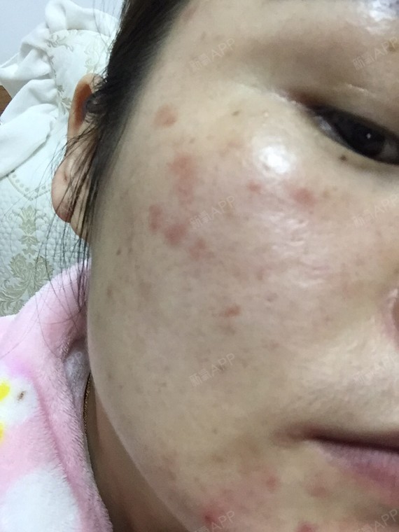 不想吐槽,这是术后一个星期的,之前打过水光,完全不_圈子-新氧美容