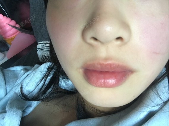 没有唇峰.很苦恼_圈子-新氧美容整形