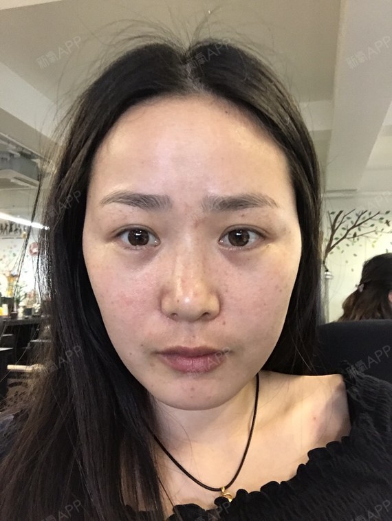 也提出了疑问,为什么眼袋又出现了,医生就还在恢复期,一个月以后主刀