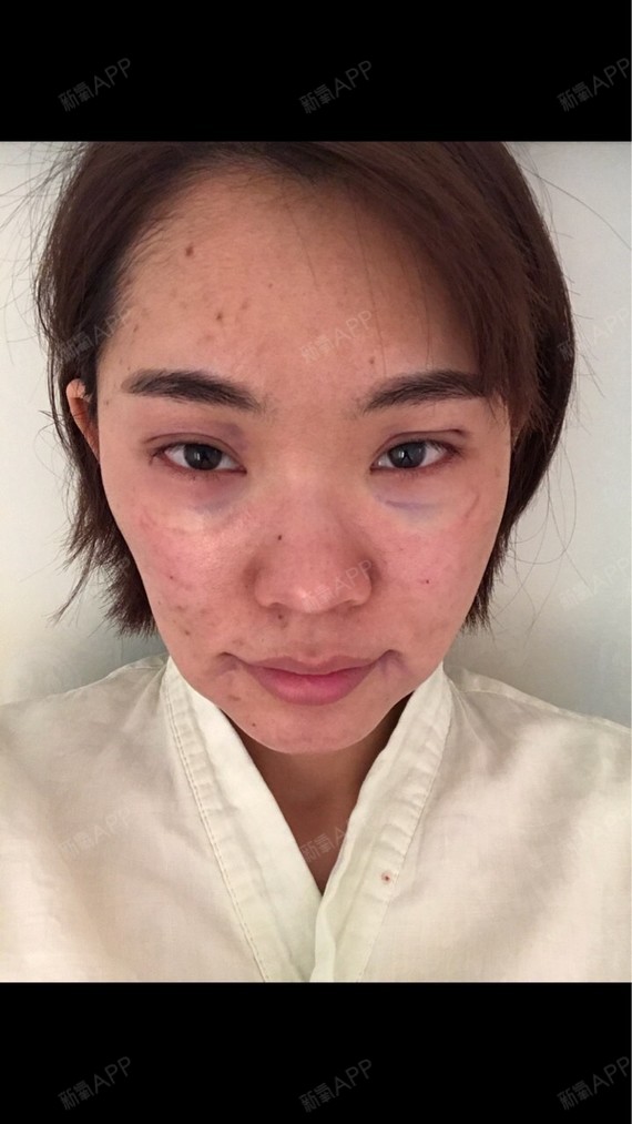 自体脂肪面部填充
