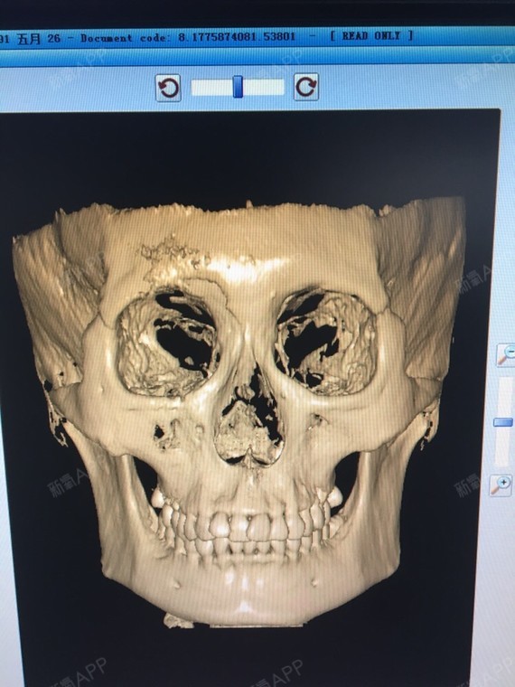 刚出炉的ct,适合下颌角吗