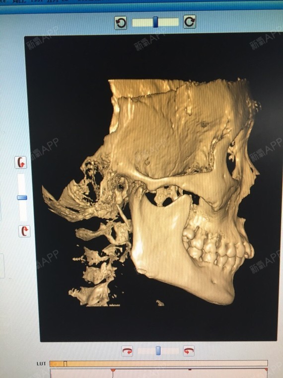 刚出炉的ct,适合下颌角吗