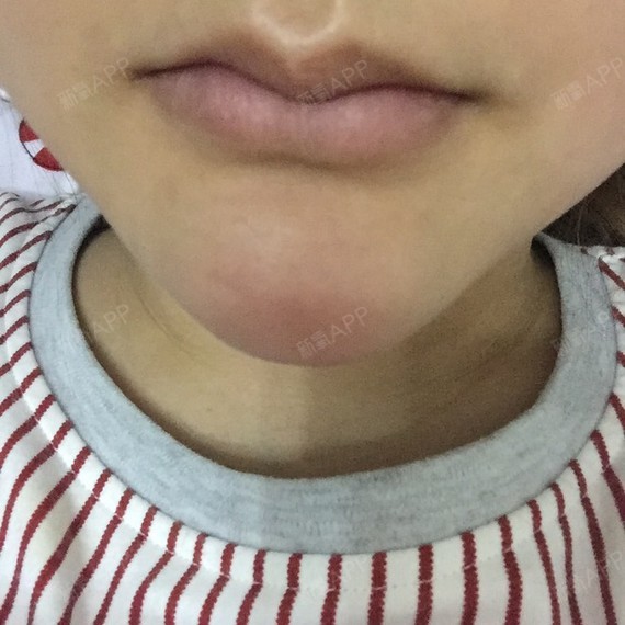 下巴打了奥美定,想取出来,最近经常红肿.