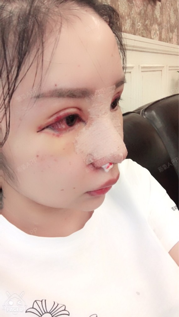 今天终于把鼻腔内的膨胀海绵取掉了,我的鼻子又能自由_圈子-新氧美容