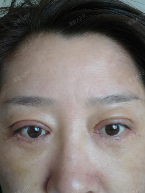 通过新氧消费方案查看外切去眼袋手术中度疼痛去眼袋机构查看吉林大学