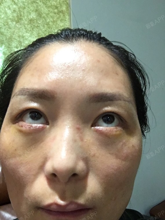 新氧- 氧气6163831493179832 | 眼部 | 眼袋 | 外切去眼袋 | 术后当