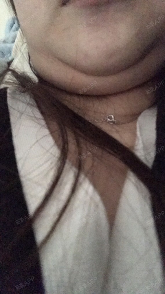 下面腮帮子还是肿的