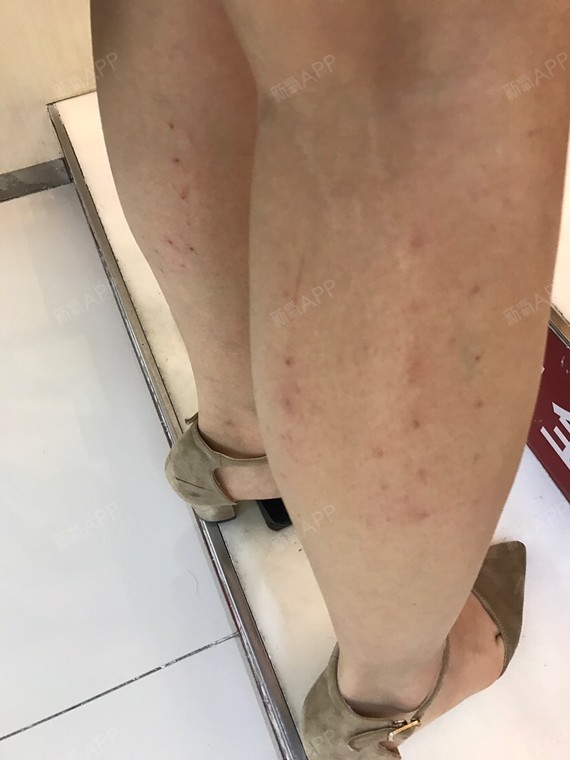 注射瘦小腿好不好_效果图_氧气_3hopc8f3a注射瘦小腿术后第1天_新氧