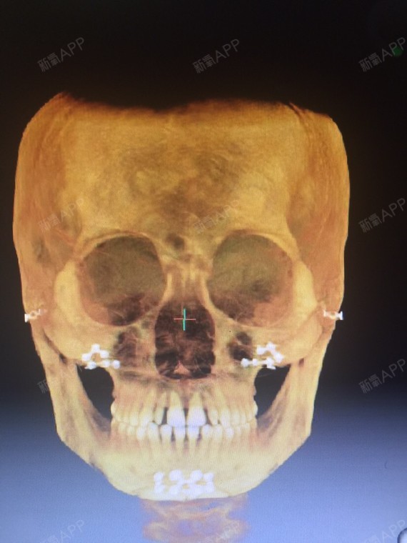 下颌角手术ct图片