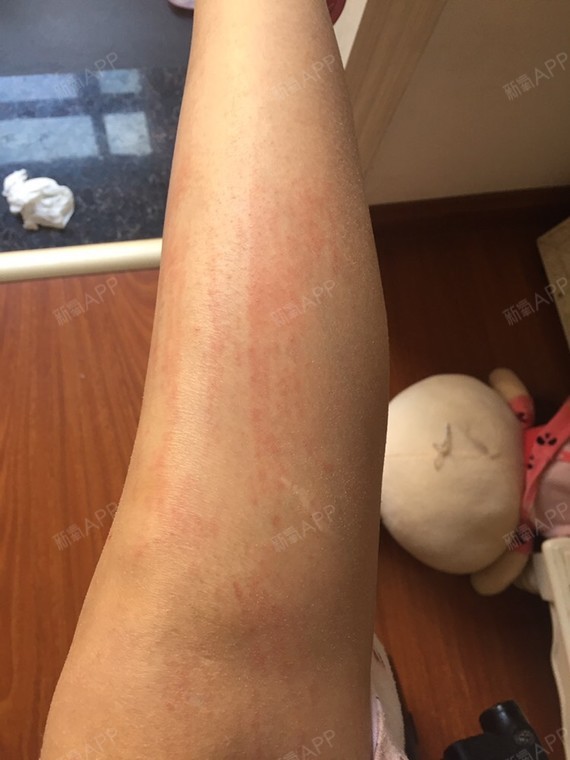 激光脱毛
