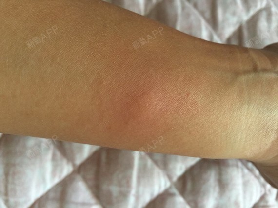 有人对溶解酶过敏吗?做了皮试肿了24小时才消.额头_圈子-新氧美容整形