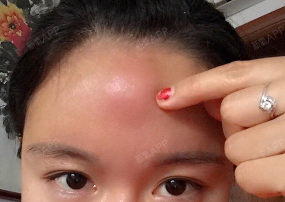 对溶解酶过敏肿硬特别厉害怎么办.额头想溶解掉.