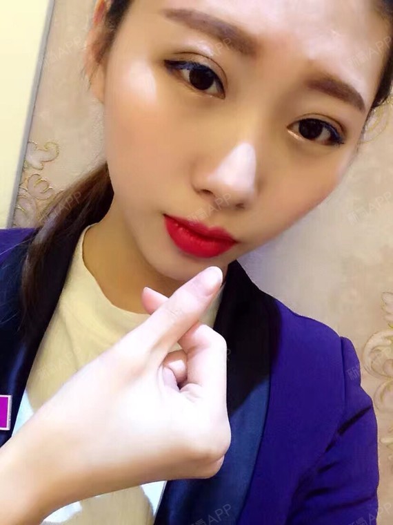 【芭比眼综合】术前及术中术后半个月反馈.