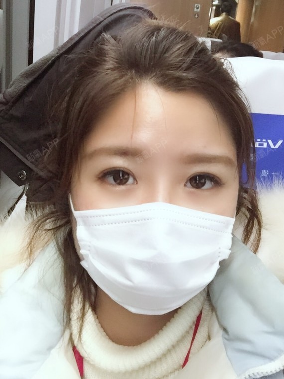 第一次用玻尿酸打鼻子,并没有想象的那么恐怖.