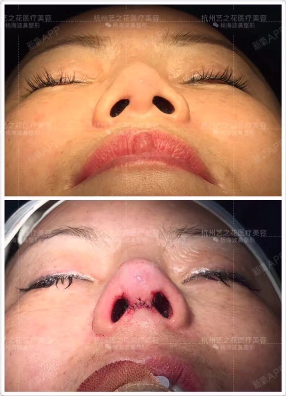 今天做一例全肋鼻整形,七个月前做过线雕鼻,术后即刻_圈子-新氧美容