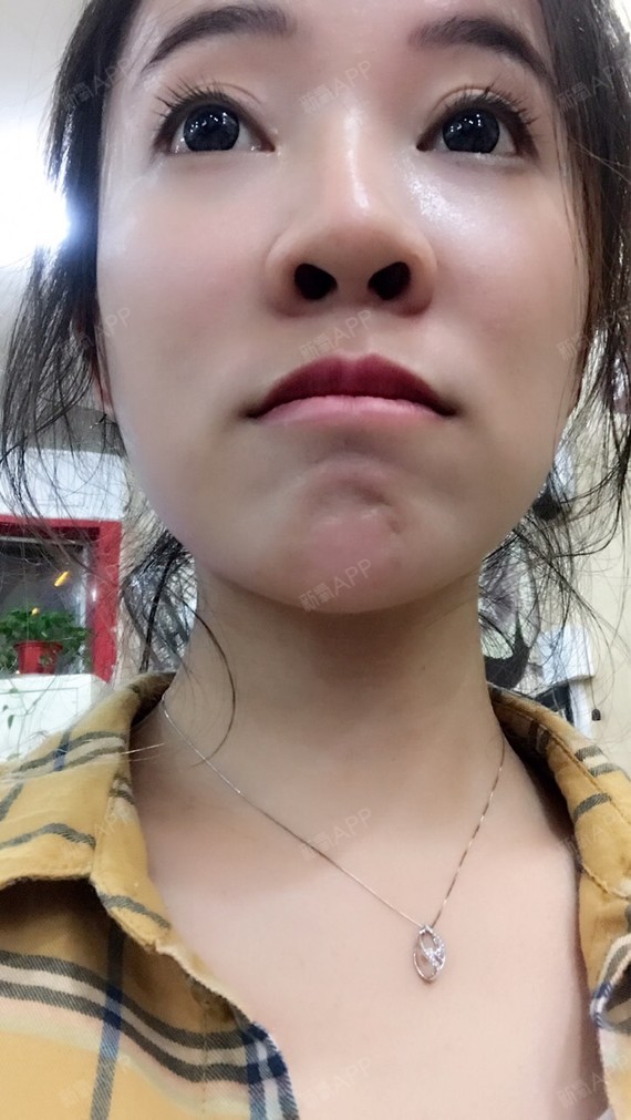 我觉得我的鼻子就是猪鼻子,好多人说我的鼻_圈子-新氧美容整形