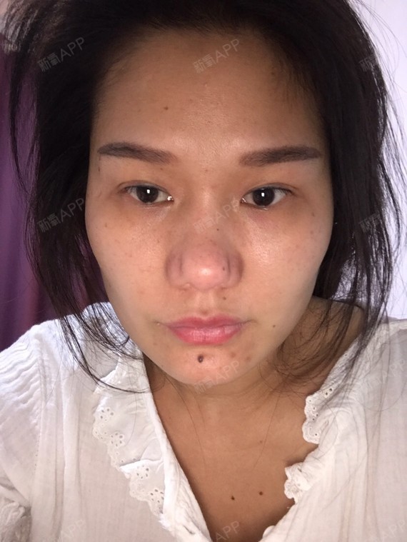 鼻子取假体后严重增生,已经五个月了,希望医生能帮我_圈子-新氧美容