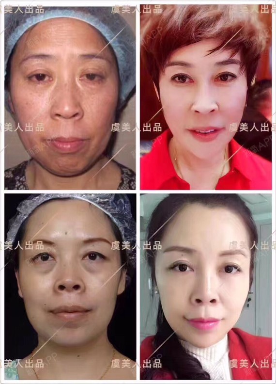 虞美人艺术面雕的意义在于,今年你年轻漂亮了,5年1_圈子-新氧美容整形