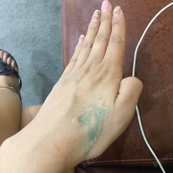 很多年前纹的纹身!现在不想要了!