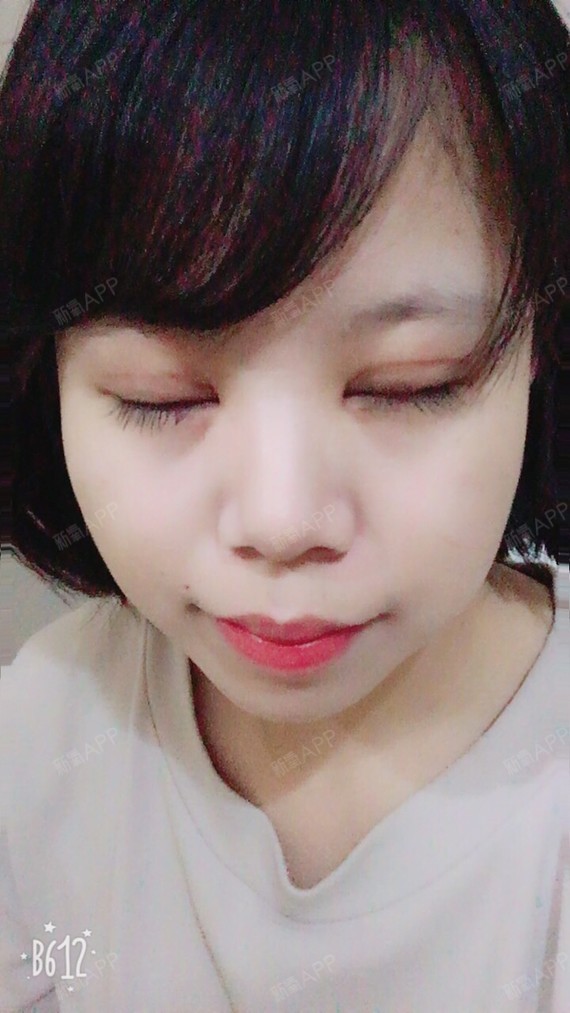 上海开内眼角好不好_效果图_只喝汽水开内眼角术后第32天_新氧美容