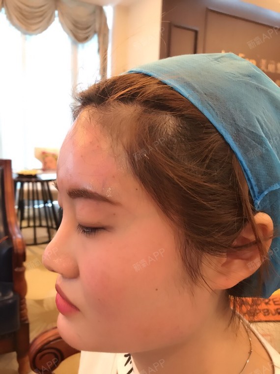 我额头天生印堂凹陷特明显,还有眉弓,总之整个额头就_圈子-新氧美容