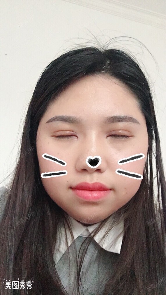 4月初做的双眼皮全切,现在肉条好明显,眼角没开好,_圈子-新氧美容整形