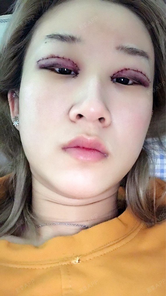 我的眼睛内眼角包的严严实实的