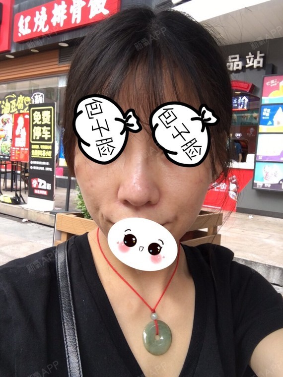 鼻骨内推太窄,鼻骨很细,两侧骨头一边凹进去.