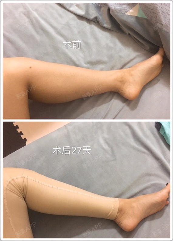 小腿吸脂第27天,上个星期开始没穿束身裤了,换了防_圈子-新氧美容整形