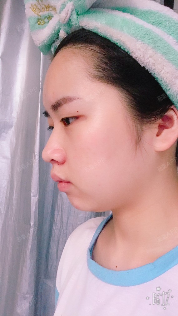 【鼻中隔延长术一次解决,短鼻,朝天鼻,鼻尖不够翘!_圈子-新氧美容整形