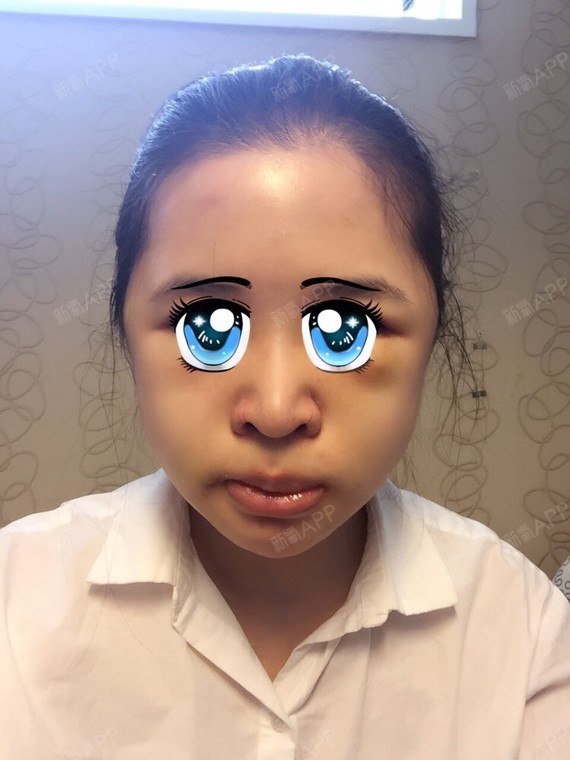 颧骨颧弓整形术好不好_效果图_pinkbaby52颧骨颧弓