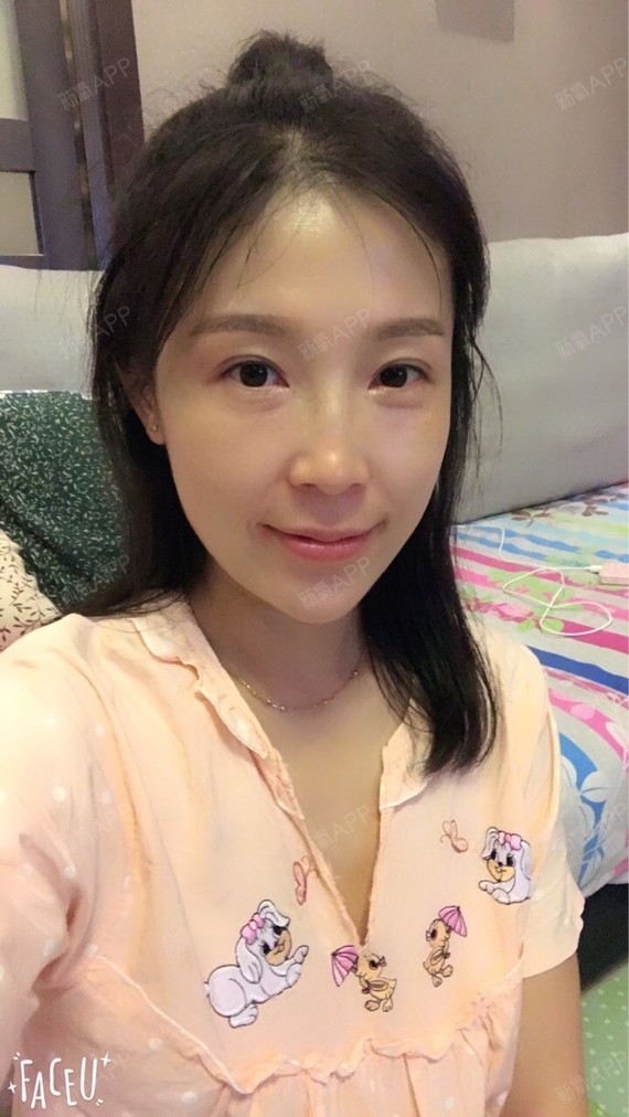 6年前奥美定注射过下巴,没有异常,但是现在想取出来_圈子-新氧美容