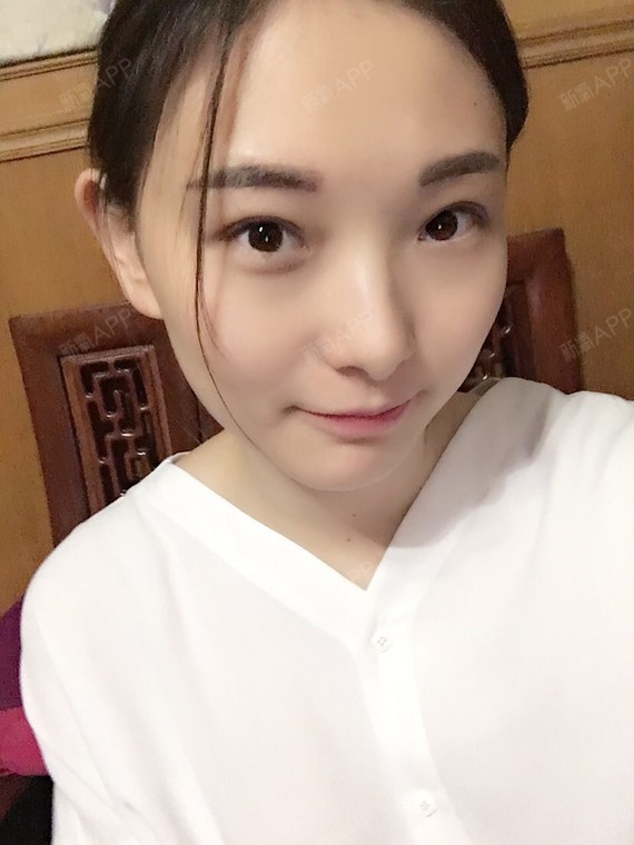 欢欢大仙儿埋线双眼皮第20天美丽日记