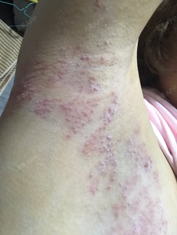 去医院看了 ,医生说是带状疱疹,是做脱毛引起的病毒感染,已经疼了我一