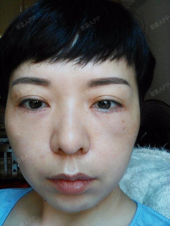 【武汉爱美汇外切去眼袋术后第0天】